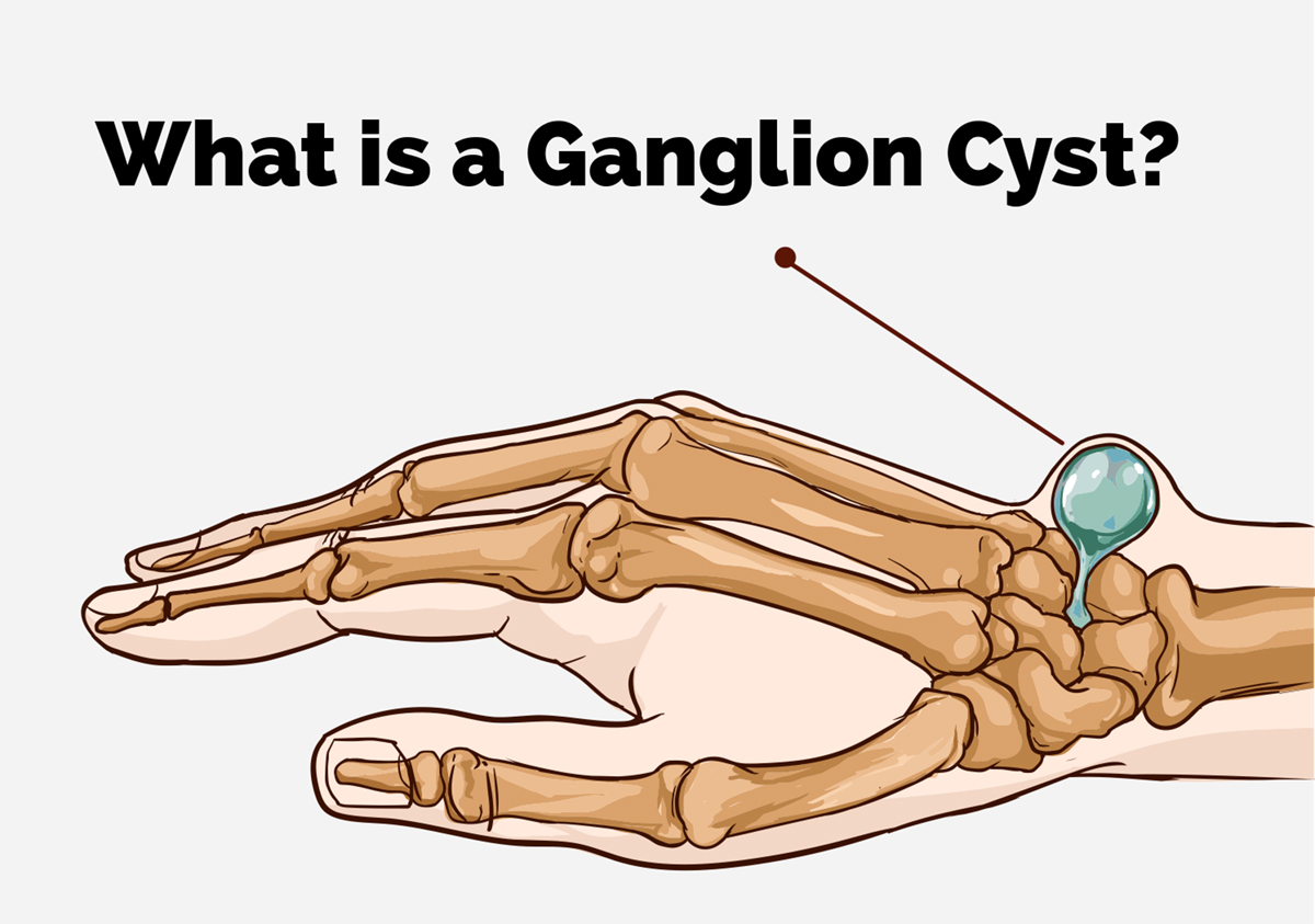 Ganglion Cysts Of The Hand And Wrist Arlington Orthopedics Associates