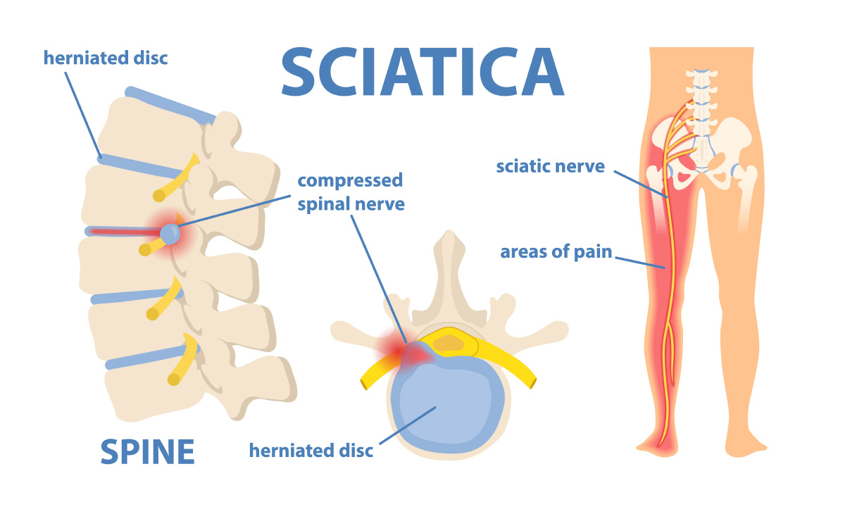 https://www.countrysideortho.com/wp-content/uploads/2021/11/countryside-ortho-sciatica.jpg